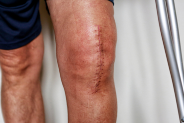 Scar Tissue's Effect on Pain and Movement » The BioMechanics Method