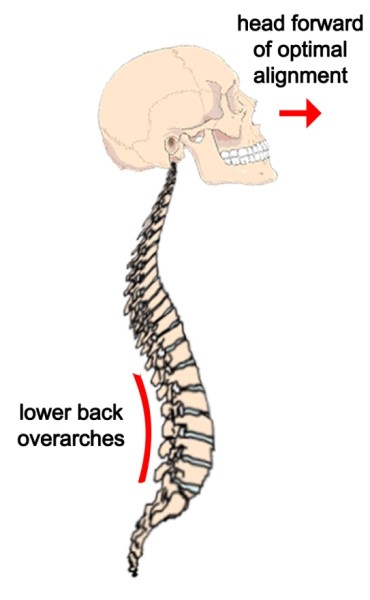 How a Forward Head Relates to Lower Back Pain