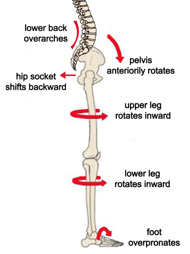 How Overpronation Relates to Lower Back Pain