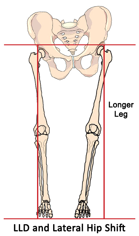 Leg Length Discrepancy and Hips Shift