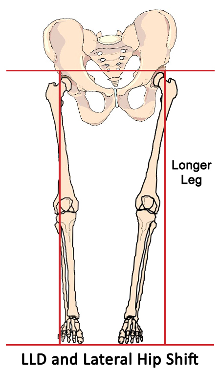 Leg Length Discrepancy