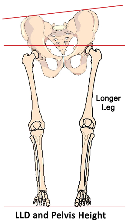 Leg Length Discrepancy and Pelvis Height