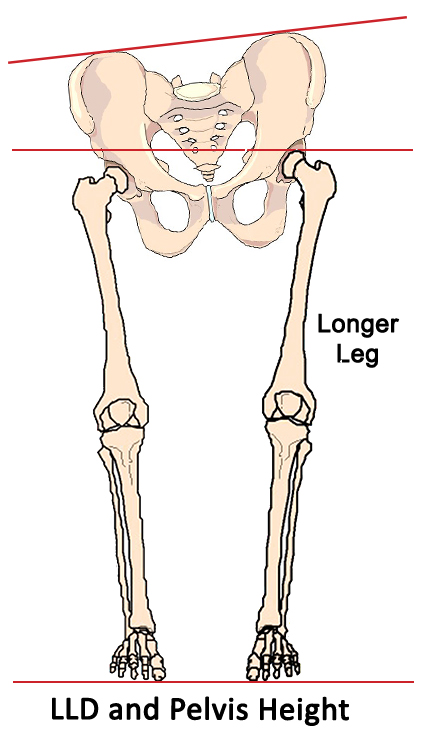 leg length discrepancy