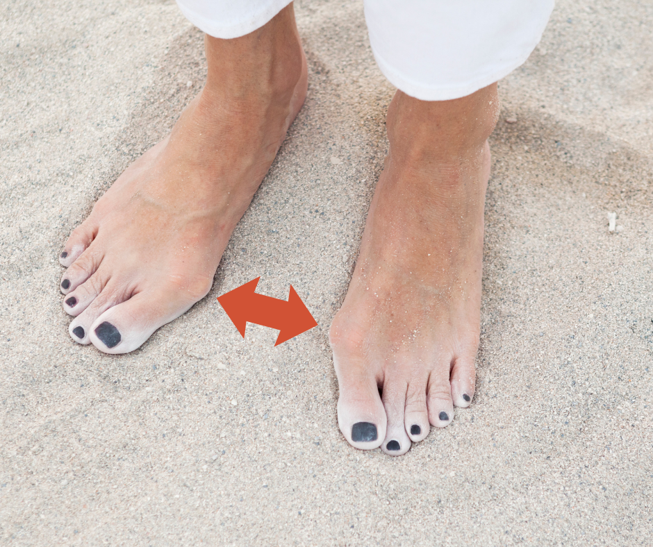 Image showing bunions indicating overpronation