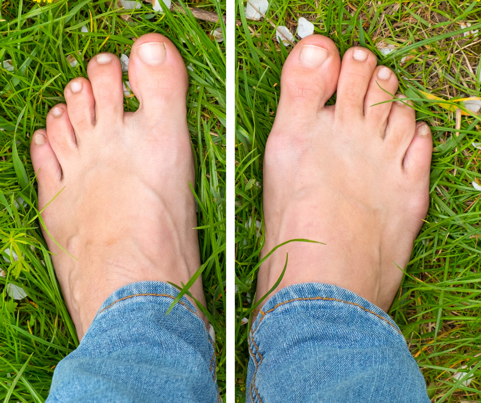 Image showing abducted foot position indicating overpronation